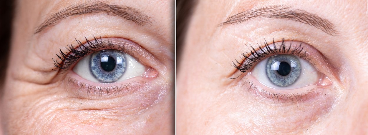 eyes-before-after
