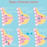 A Comprehensive Guide to Breast Cancer