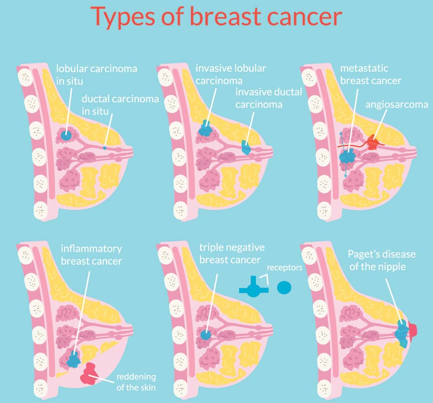 Types of Breast Cancer