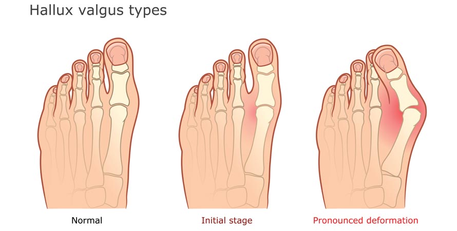 Signs Of Bunions