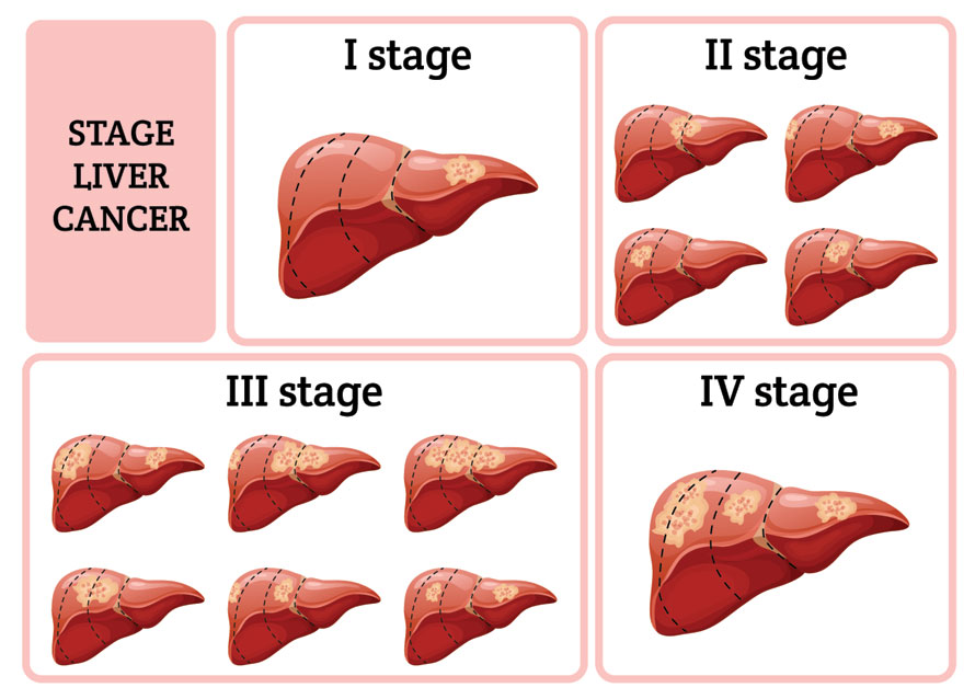 Stages Of Liver Cancer
