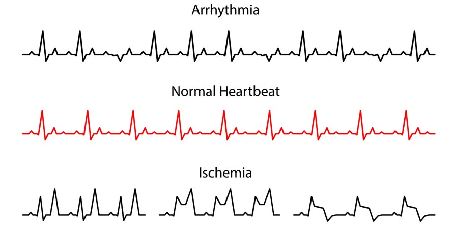Arrhythmia