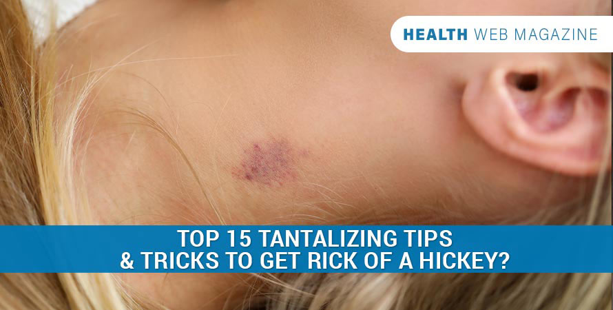 Get Rid Of A Hickey