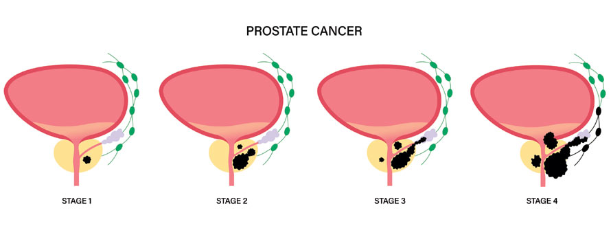 Stage 4 Prostate Cancer