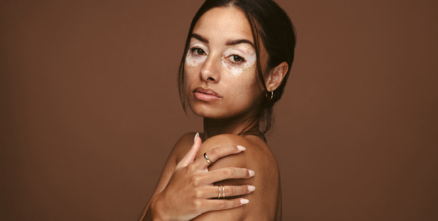 Signs And Symptoms Vitiligo
