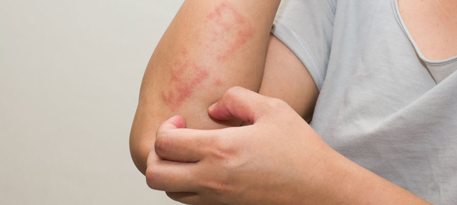 Eczema and Psoriasis