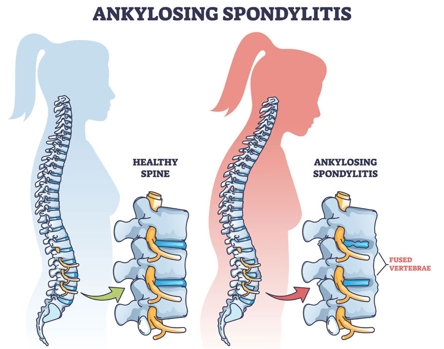 Diagnosis of ankylosing spondylitis