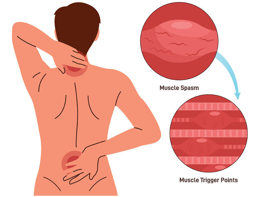 Symptoms of back spasms