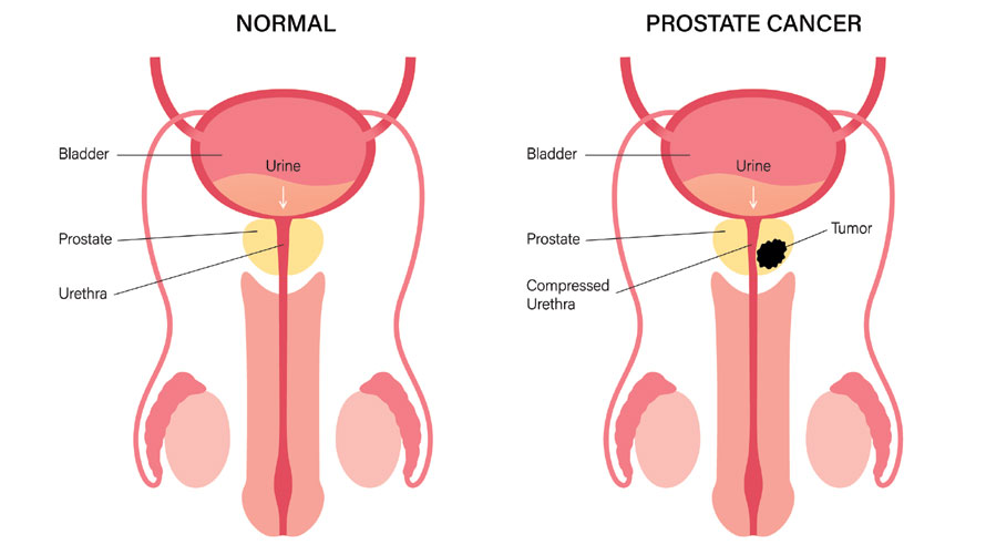 Symptoms Of Metastatic Prostate Cancer