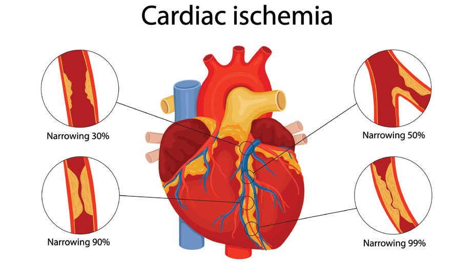 Cardiac-ischemia