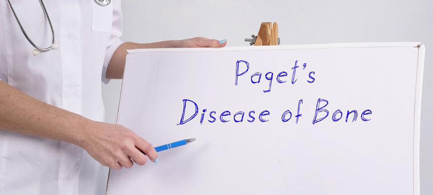 Paget’s Disease of Bone