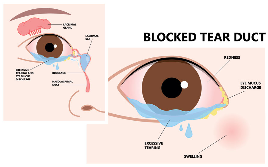 Blocked Tear Duct Diagnosed