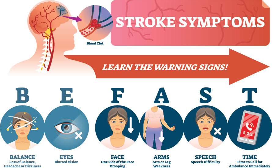 Stroke symptoms