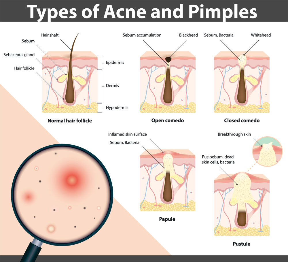 Types of Pimples