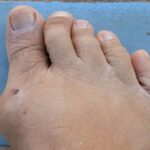 A Complete Guide for Gout – Signs, Causes, Symptoms, & Treatment