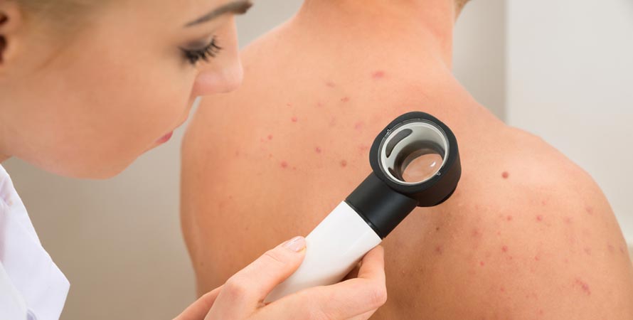acne breakouts is your hormones