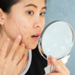 How to Get Rid of Acne Scars: 7 Effective Home Remedies