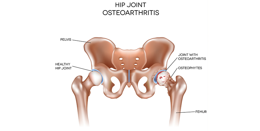 understanding hip pain