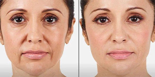 Remove the Signs of Aging