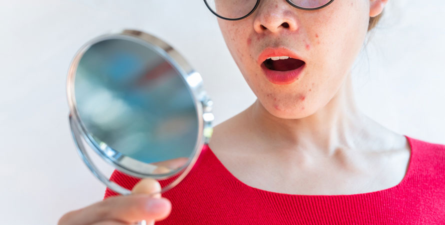Causes Hormonal Acne