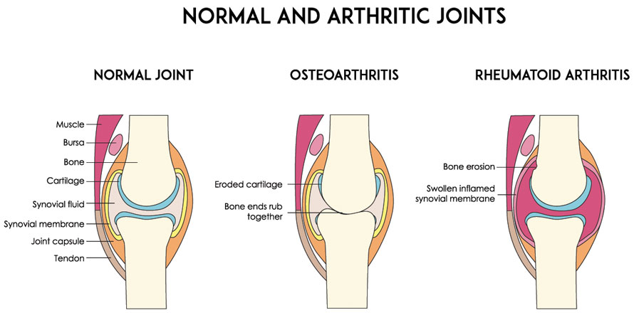 diagnosis for rheumatoid arthritis and osteoarthritis