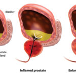 5 Effective Natural Remedies That Can Help Treat Enlarged Prostate