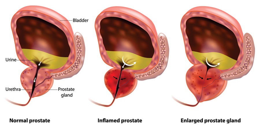 Enlarged Prostate Symptoms