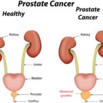 The Complete Overview on Prostate Cancer