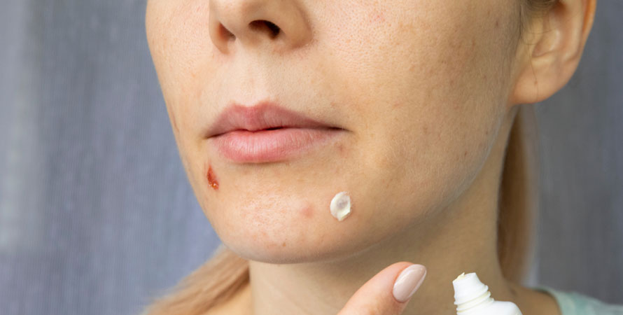 Get rid of hormonal acne