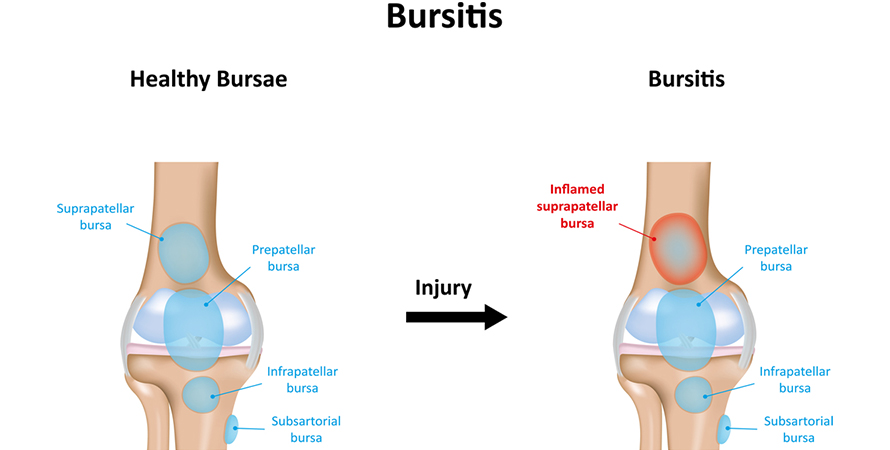 bursitis 