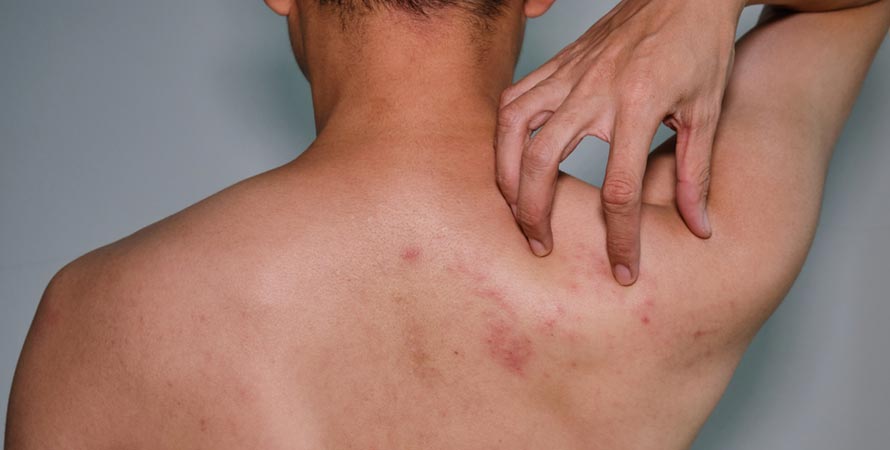 Prevent Back Acne