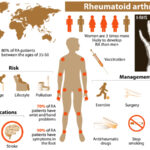 10 Most Recommended Home Remedies for Rheumatoid Arthritis