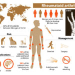 What are the Signs, Symptoms And Treatments for Rheumatoid Arthritis?