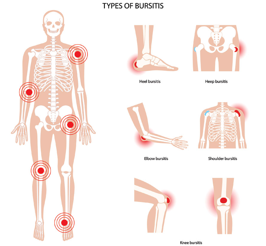 Types of Bursitis